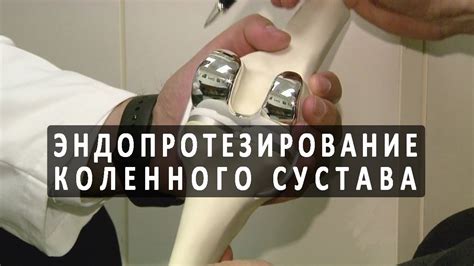 Операция по протезированию коленного сустава - YouTube