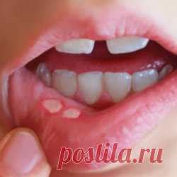 Белые язвы во рту — причины, симптомы, лечение и профилактика | Лучшие ...