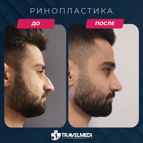 Ринопластика - TravelMEDI