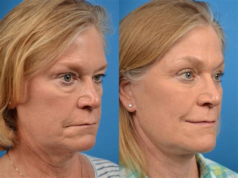 Asian Brow Lift Before And After - Brow Lift Surgery Photos | Philadelphia - Elizabeth Essfull85