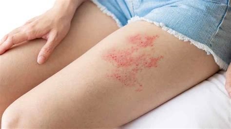 Get Shingles Treatment in Swindon - Home Ground Pharmacy