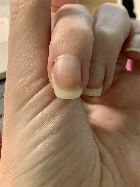Nail broke really high up months ago and won’t grow back normally? More