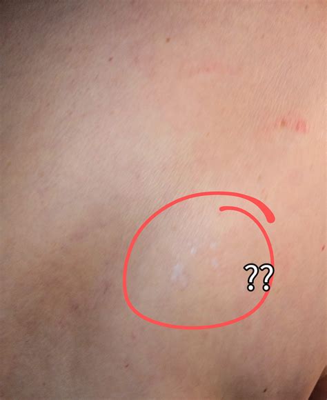 Permanent rash/hives : r/CIRS
