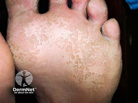 Pitted Keratolysis Images — DermNet