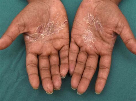 hand eczema   treatments eczemaorg