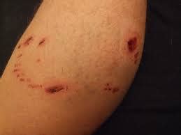 Dog Bite Payouts Increasing across the country so be careful