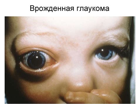 Постепенная потеря зрения - презентация онлайн