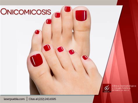Tratamiento para la Onicomicosis - Laser Puebla