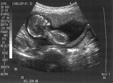 history  fetal ultrasound pregnancy imaging  science