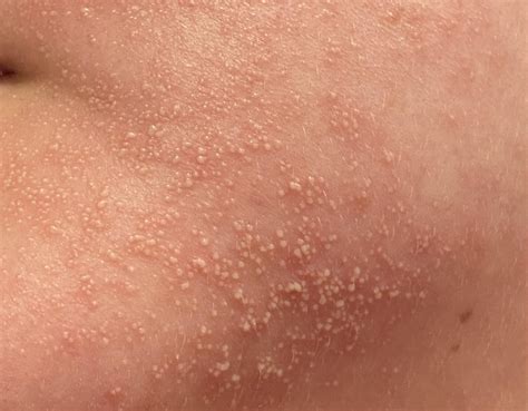 I believe this is an allergic reaction to (info in OP comment) makeup ...