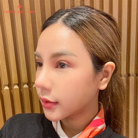 how to fix double eyelid