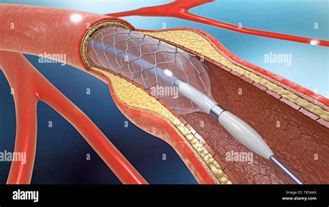 arterial stent illustration stock photo alamy