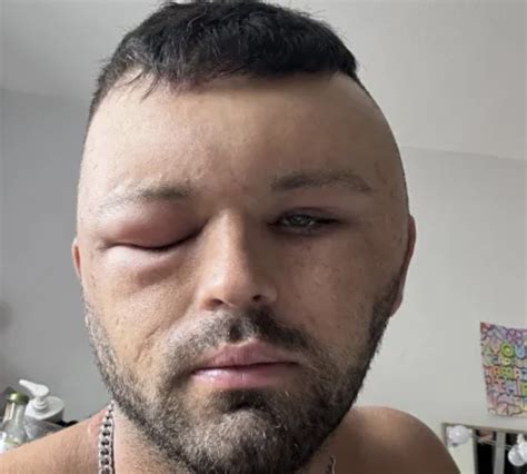 Photos Showing How Bad an Allergic Reaction Can Be | eBaum's World