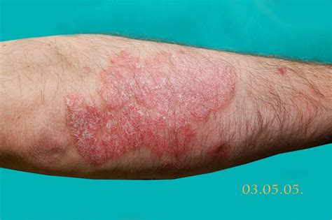 Dermatologija | Naftalan