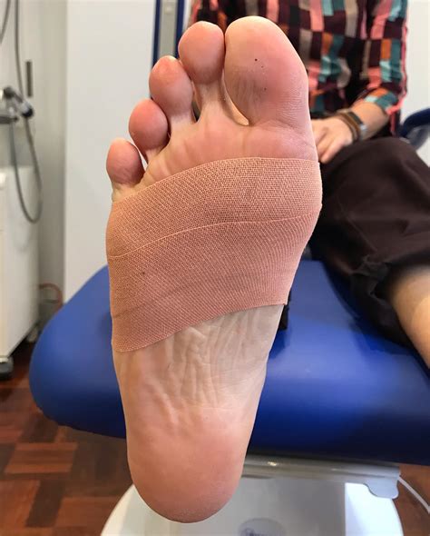 City - Example of Taping method that you might benefit from if you have