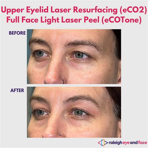 Laser Skin Resurface Before and After — Raleigh Eye and Face