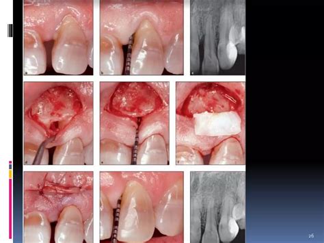 Connective tissue grafts | PPTX
