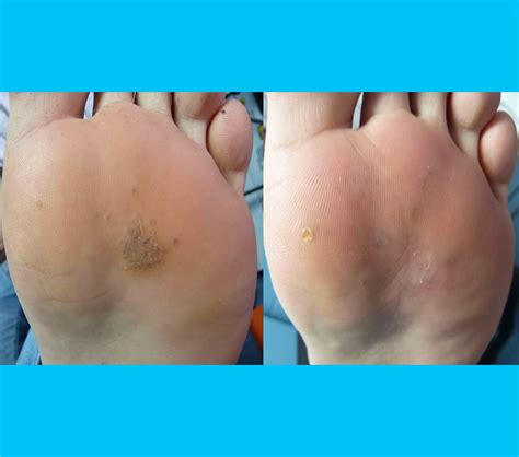 Plantar Wart Treatment | Case Study 2 - Laser Wart Treatment | Wart