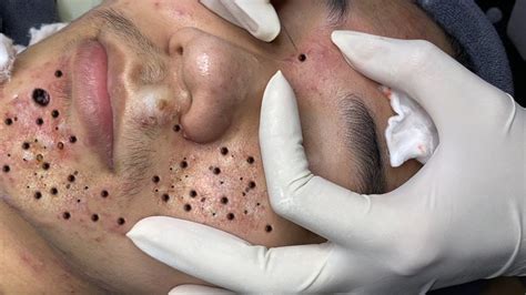 Is Unbelievable Blackhead Removal 2024 Right for Your Skin Type? Find Out Now! - ft1x19b