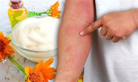 Eczema treatment: Prevent dry and itchy skin with a calendula cream ...