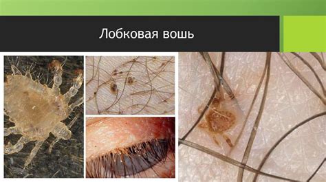 Организация и проведение мероприятий по борьбе с педикулезом ...