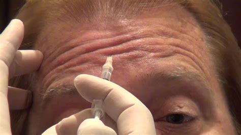 Botox Training - Forehead Injections - Empire Medical Training - YouTube