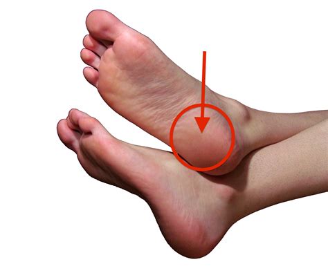 Pain On Bottom Of Calcaneus at Nina Roberts blog