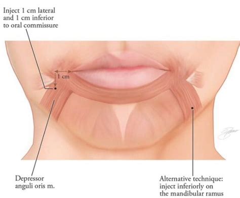 Lip injections lip anatomy poster hyaluronic acid filler – Artofit