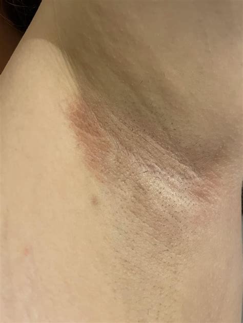 Rash appeared in armpit : r/DermatologyQuestions