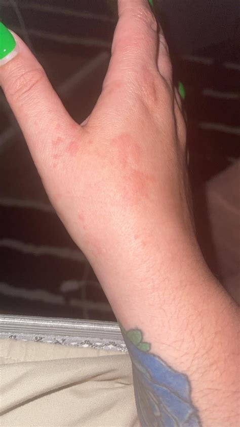 Is this urticaria? : r/urticaria