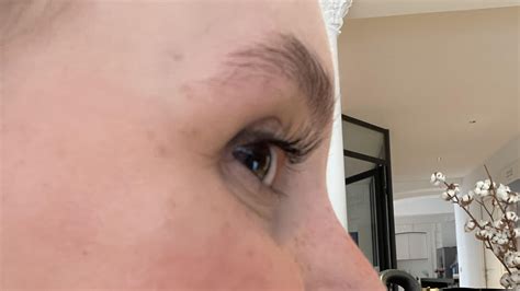 Under eye hollows - good candidate for filler? : r/PlasticSurgery