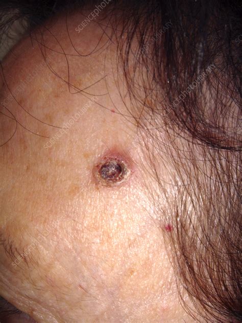 Squamous cell carcinoma on a woman's forehead - Stock Image - C058/3081 ...