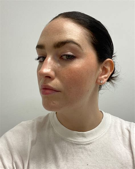 face fillers cost 4