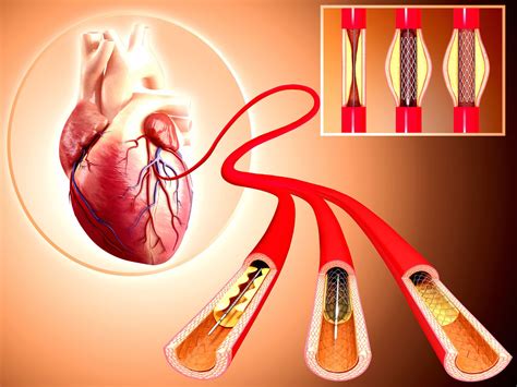 The Survival Rate After Stent Placement - Health Living Advocate