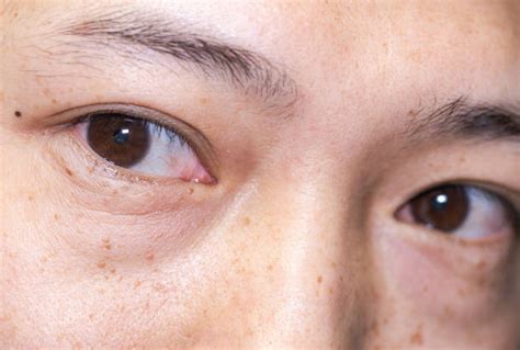 30+ Bulging Cornea Stock Photos, Pictures & Royalty-Free Images - iStock