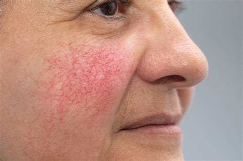 Rosacea On Cheeks