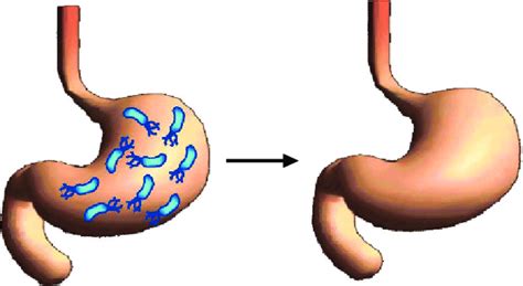 Helicobacter Pylori Test – TestEasy