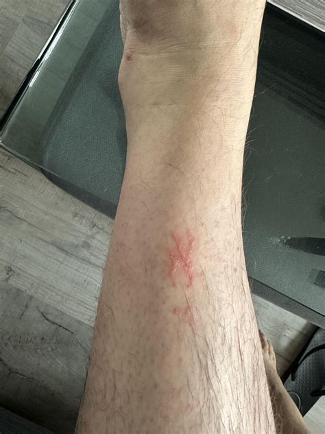 Leg rash : r/DiagnoseMe