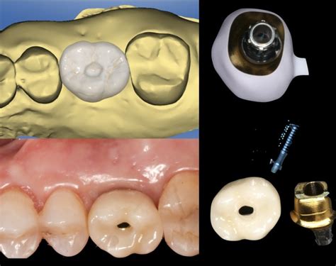 Routine place and restore with azento | CDOCS Article