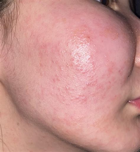 Is this is an allergy rash? Please help. Going to take benadryl with