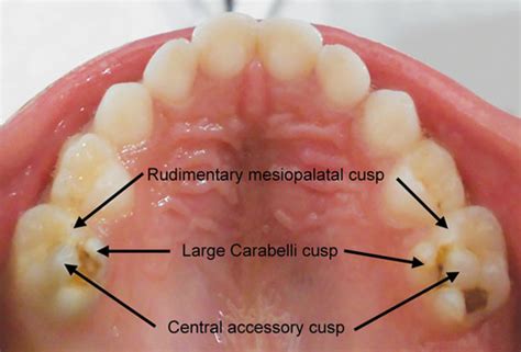 Carabelli Cusp Mandibular