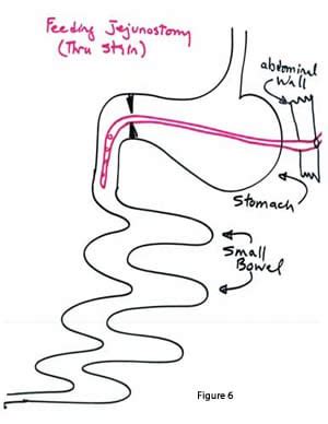 feeding-tube-06 - DSSurgery