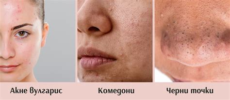 Видове акне: как да ги разпознаем и лекуваме?