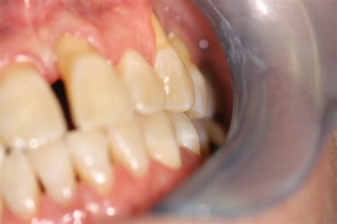 Smile Gallery - North Austin Dentistry - Logan Miller, DDS