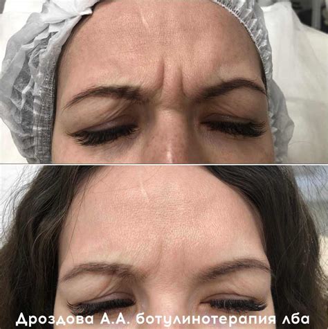 Ботулинотерапия лица