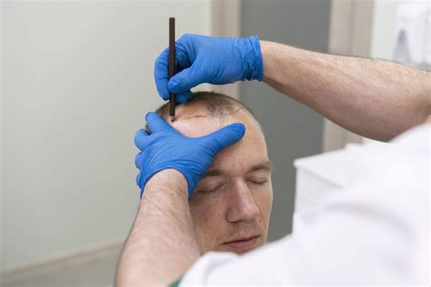 What Does Turkey Hair Transplant Package Include?