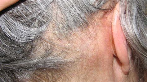 Seborrheic Dermatitis Scalp
