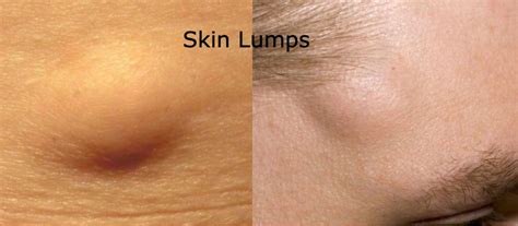 Skin Lump Surgery Singapore - Lipoma Removal Procedure