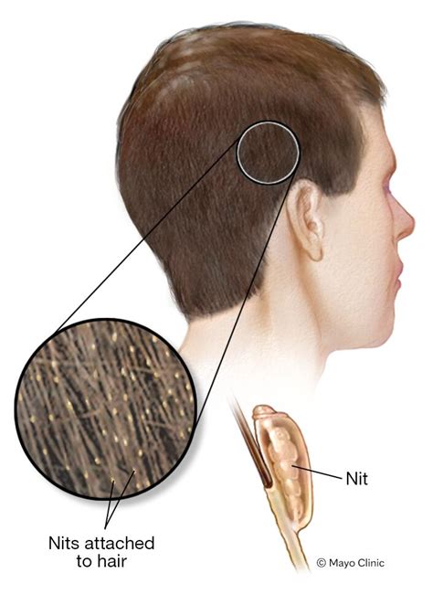 Nits In Hair Contagious at markcallen blog