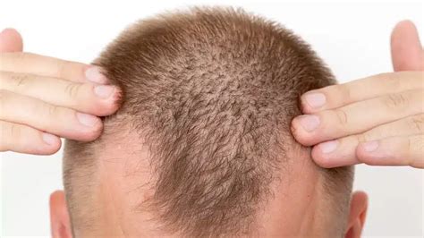 What Do Dead Hair Follicles Look Like? Signs and Identification